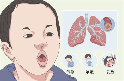 小孩子一直咳嗽|用药问答：儿童反复咳嗽不愈，可能病因有哪些？